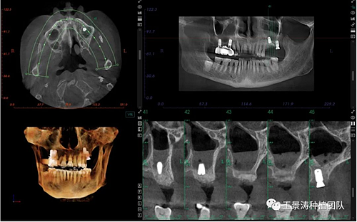 后牙區(qū)即刻種植的適應(yīng)癥的思考 后牙區(qū)即刻種植的適應(yīng)癥的思考