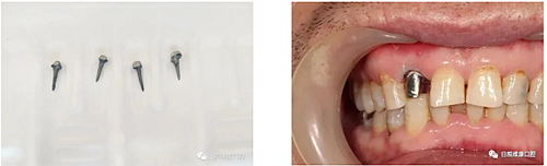 d7a口腔科普 | 殘根殘冠怎么辦——樁核冠 d7a口腔科普 | 殘根殘冠怎么辦——樁核冠